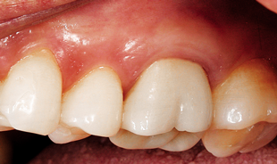 Final buccal view of dental restoration