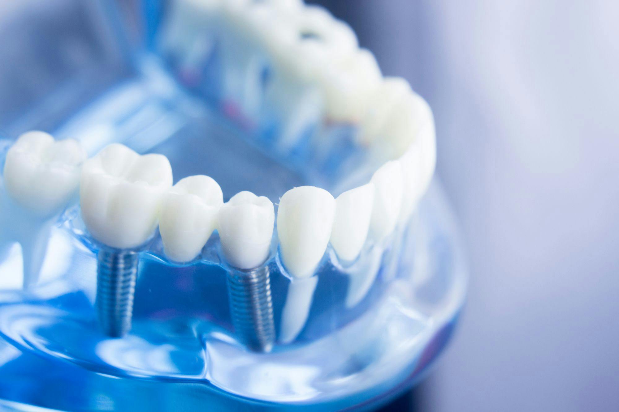 A Look at What’s on the Dental Implant Horizon. Image courtesy of edwardolive/stock.adobe.com. 