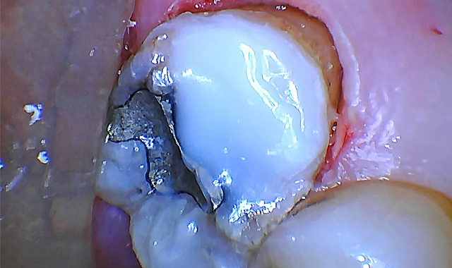 Figure 5 post-op with temporary restoration