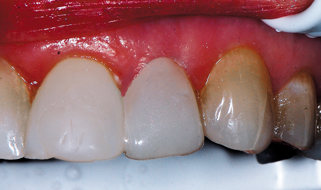Estelite Sigma Quick composite in a shade A2 was adapted and shaped to the tooth to build out the facial contour to blend better with the adjacent teeth. 