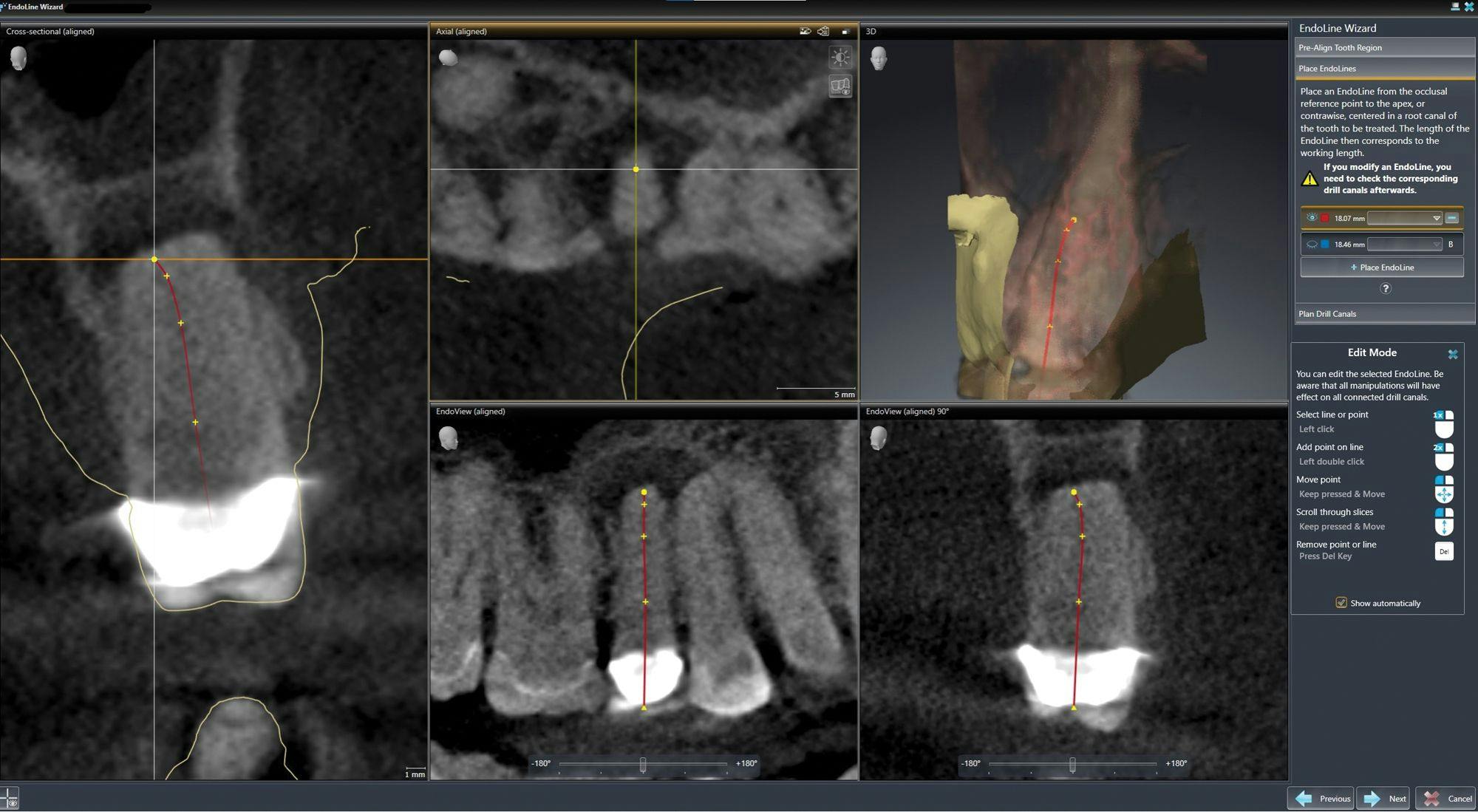 How to Use Imaging and Treatment Planning Software for Guided Endodontic Therapy