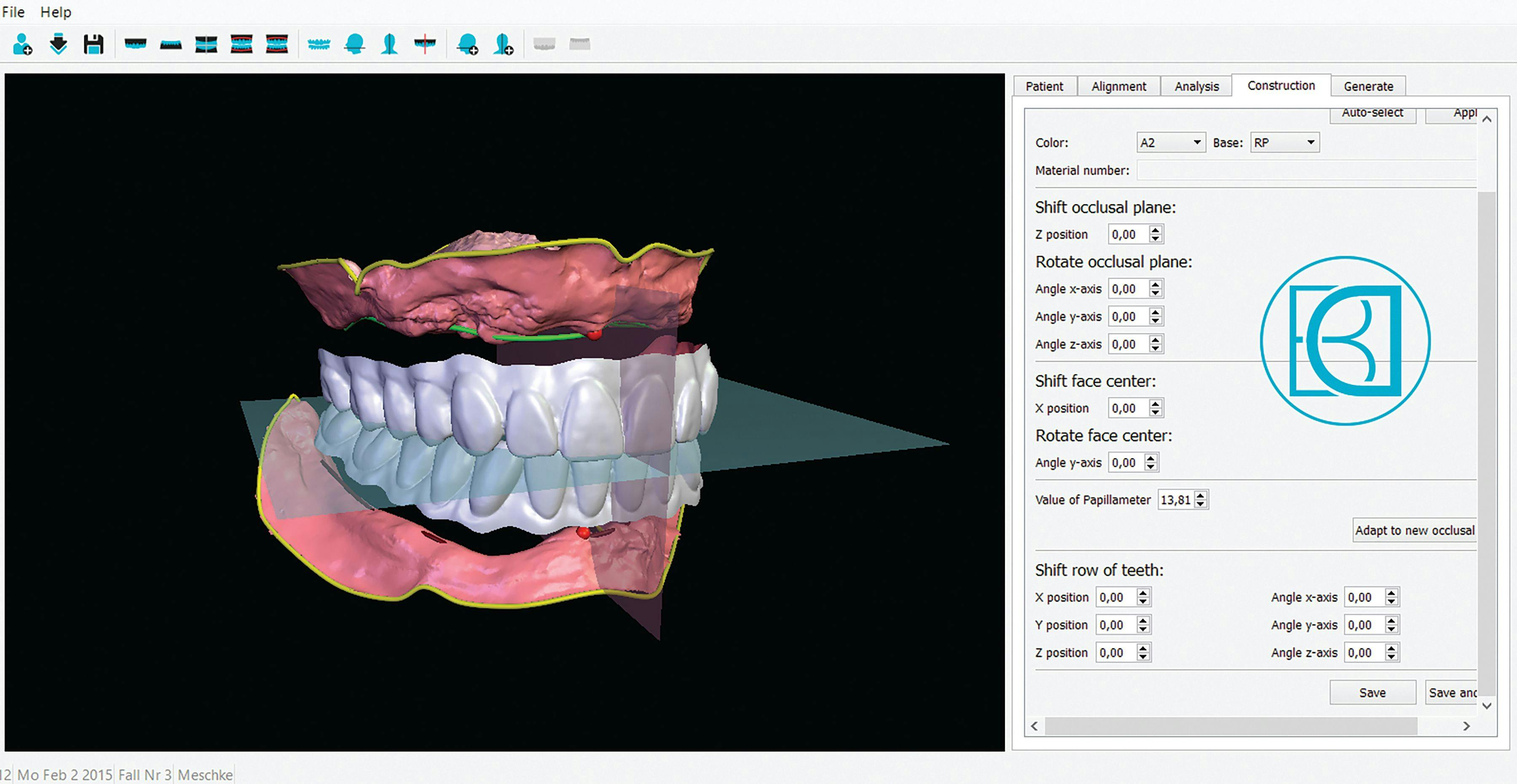 BDCreator PLUS is used to design a set of dentures.