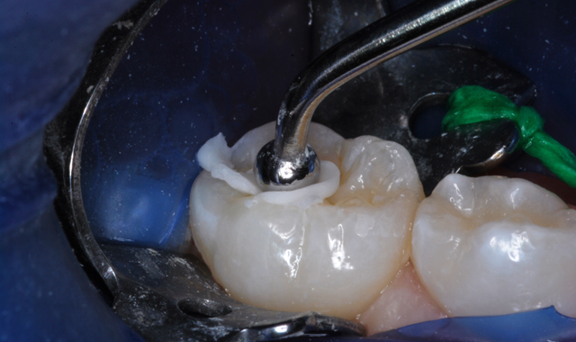 How to use a glass ionomer to fill an occlusal caries lesion