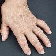 Bacteria Responsible for Periodontal Disease Might Also Cause Rheumatoid Arthritis