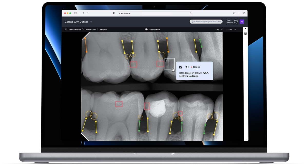 Videa Dental Assist from VideaHealth. Image credit: © VideaHealth