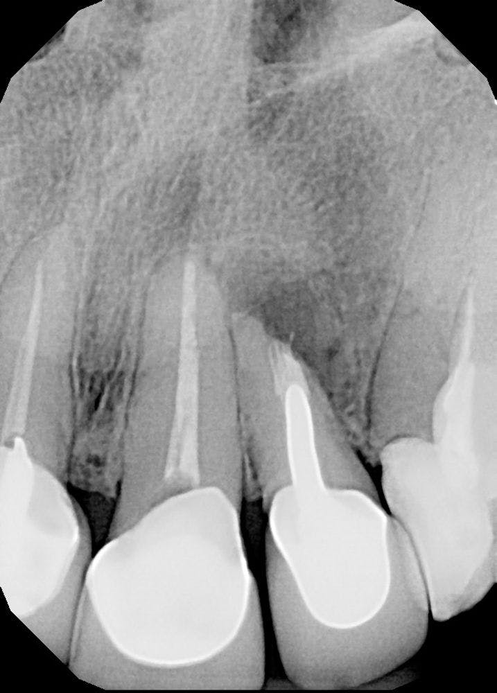 Deep Dive: Dental Lasers Enhance Root Canal Treatments for Both Patients and Providers