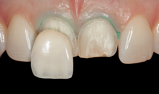 What to look for when cementing thin-walled restorations