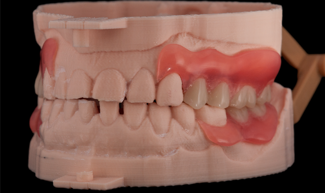 Left lateral view of the completed dentures