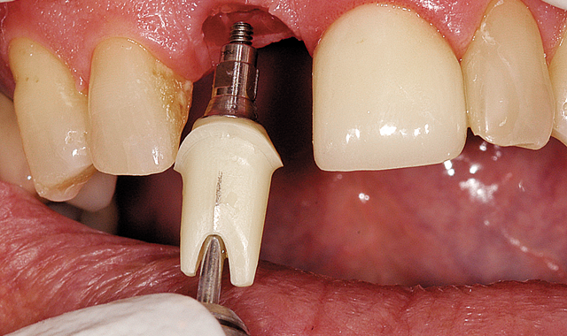 How to obtain state-of-the-art esthetics, precision and biologic stability with dental implant restorations