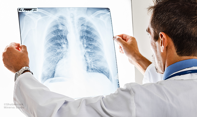 Gum disease may increase lung cancer risk