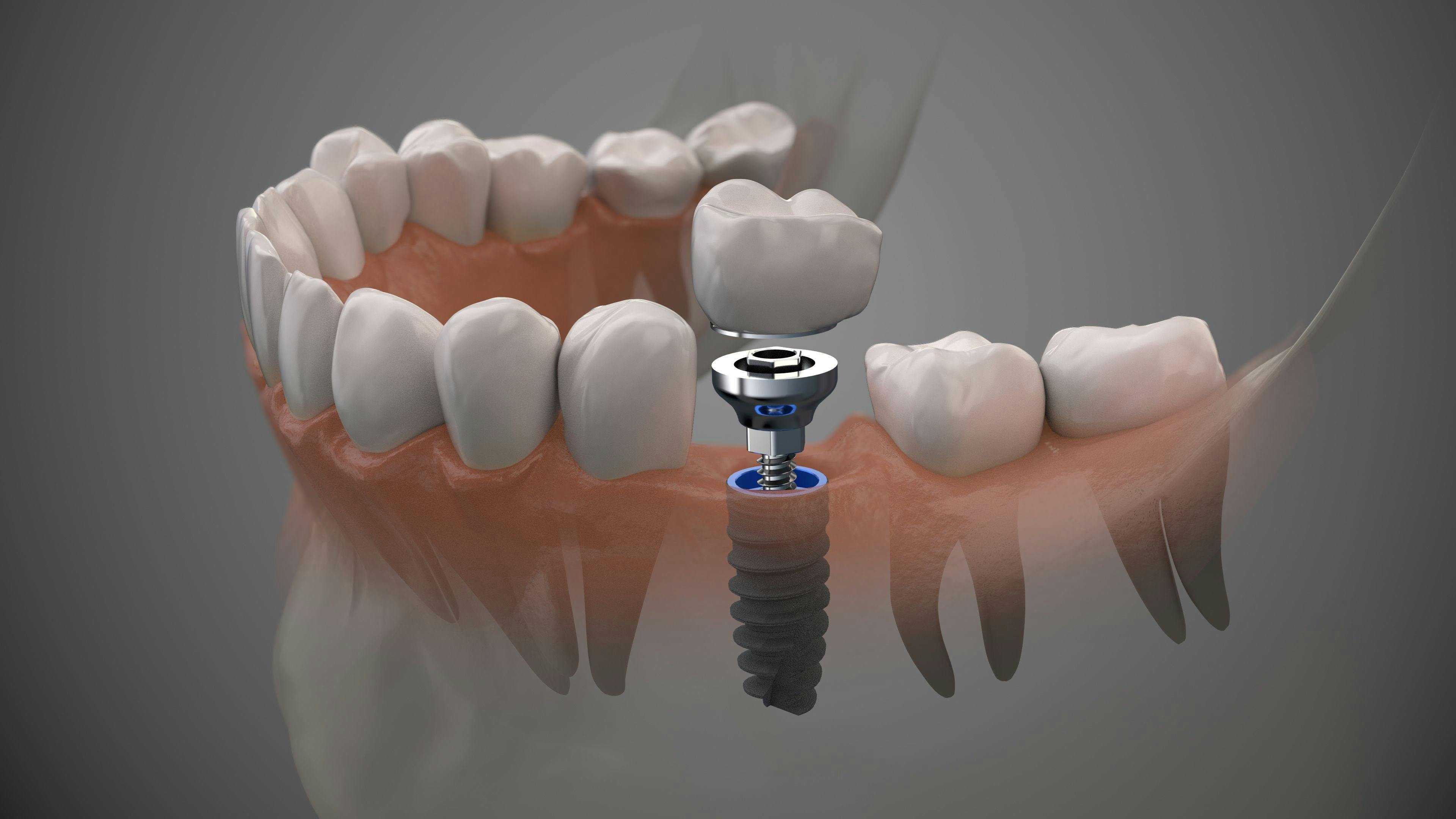 cement-retained dental implant – labden / stock.adobe.com