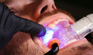 Curing a dental restoration