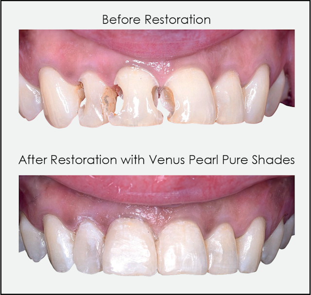 New Venus Pearl Pure Shades Formulated to Simplify Dental Restorations  | Image Credit: © Kulzer North America