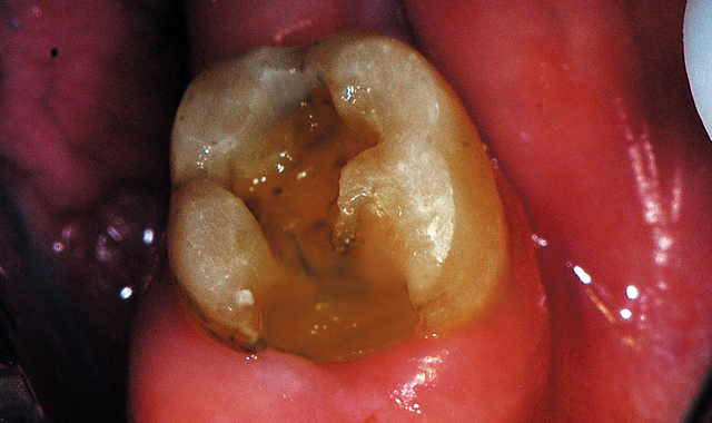 Defective amalgam and caries removed and tooth presents with dark dentin and some underlying staining which were non-sticky to the explorer. 