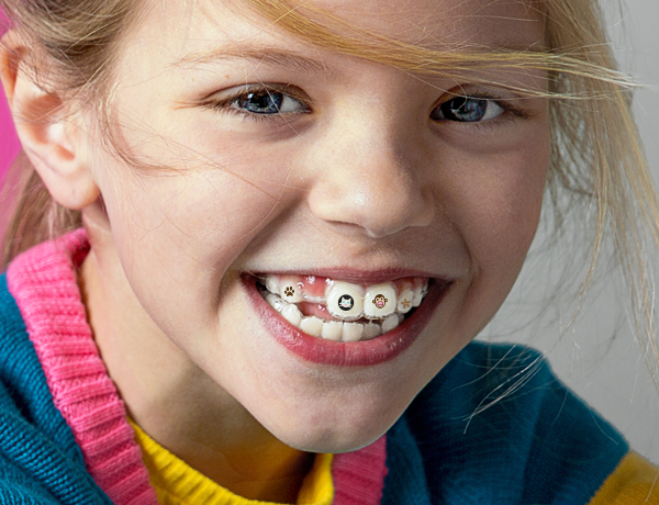 Align Technology’s new Invisalign Stickables designed to personalize clear aligners 
