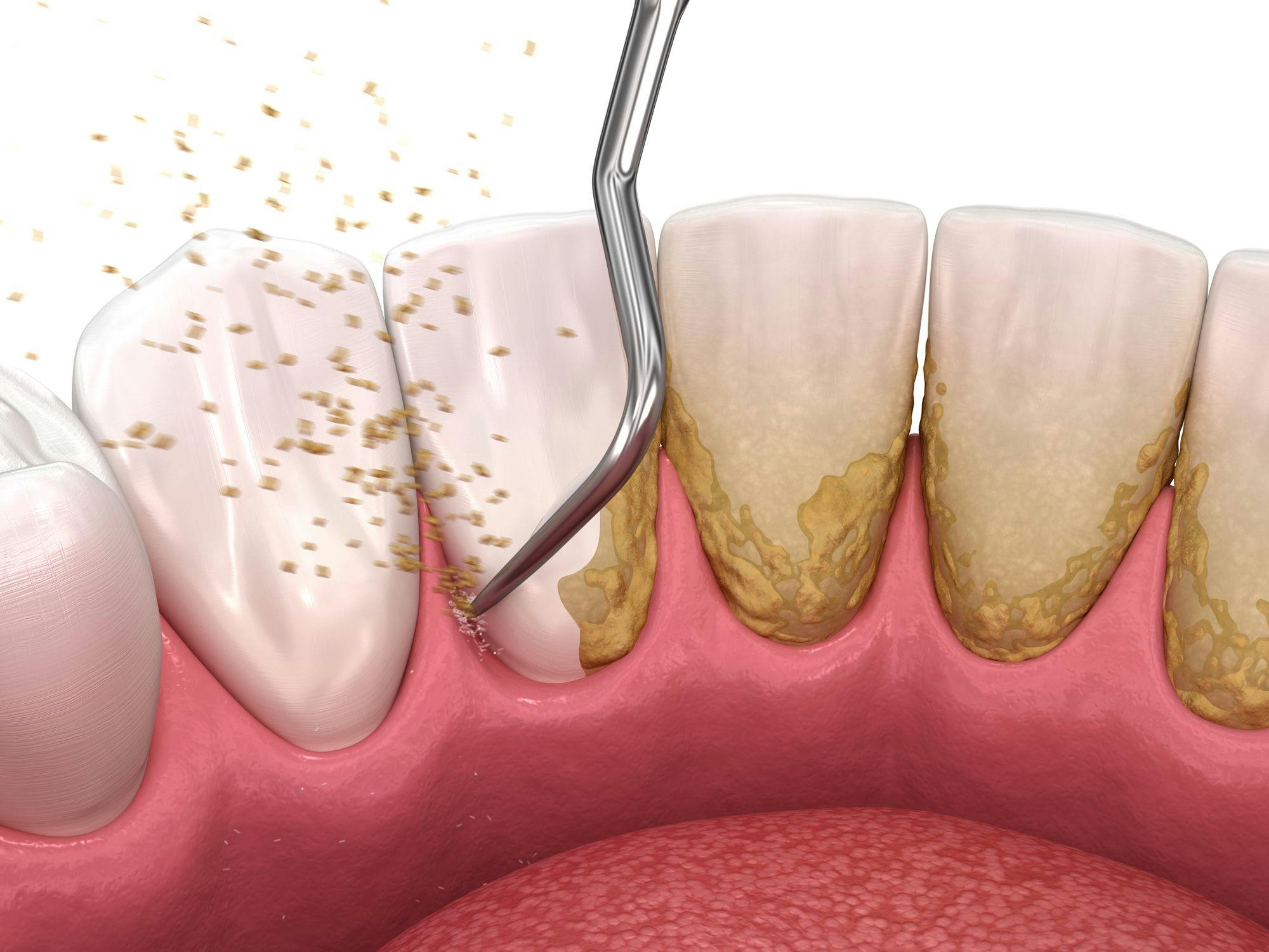 The Evolution of Nonsurgical Periodontal Therapy: A Three-Part Series. Photo courtesy of Alexander Mitiuc/stock.adobe.com. 