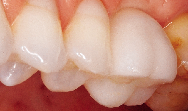How to Efficiently Place a Cemented Implant Crown