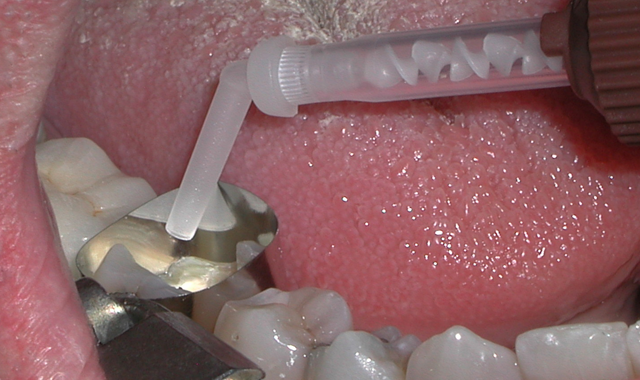 Fig. 4 Dispensing CompCore AF (Premier Dental) into the tooth to complete the post and core