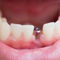 Coatings with Antibacterial Properties Being Designed for Dental Implants
