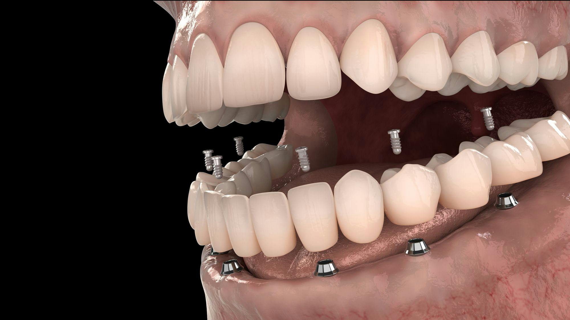 Getting Started with Implant Overdentures. Photo courtesy of lightmachine/stock.adobe.com. 