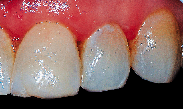 Patient presented with complaint that the left lateral incisor was slightly palatal in comparison to the adjacent central incisor and canine and gave the tooth a slightly darker tone as a result. 