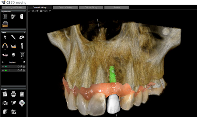 Carestream Dental introduces CS Solutions for Implants