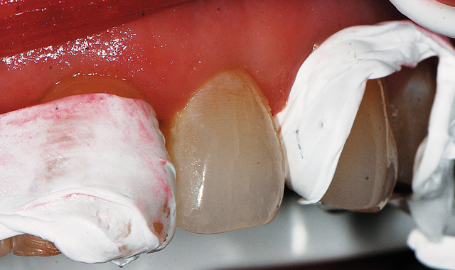 Teflon tape placed and adapted to the adjacent teeth.