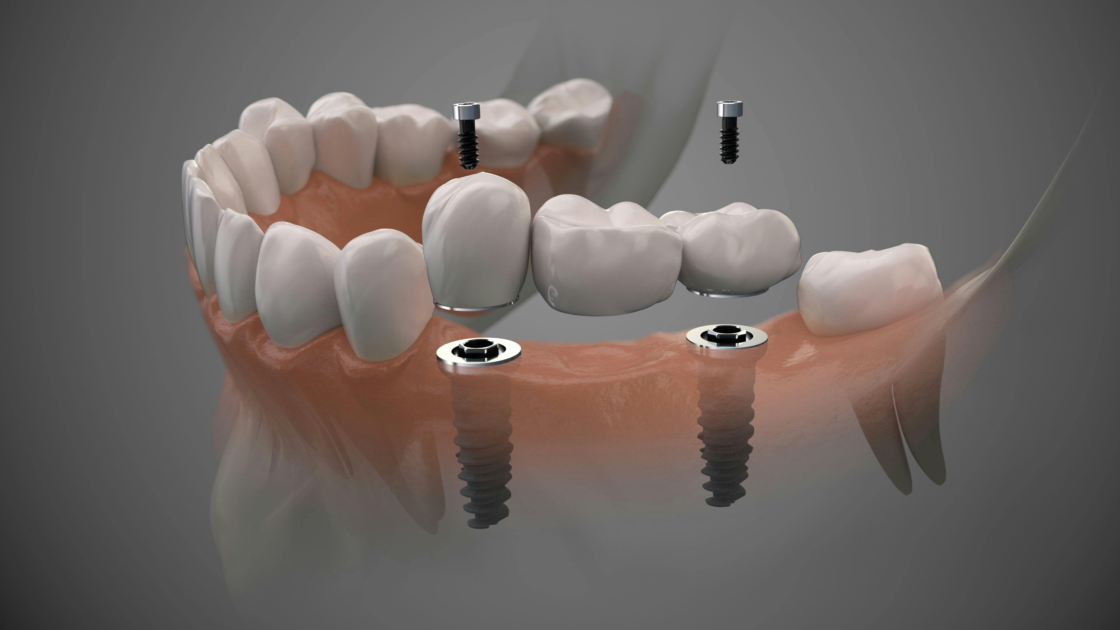 screw-retained dental implant bridge – labden / stock.adobe.com