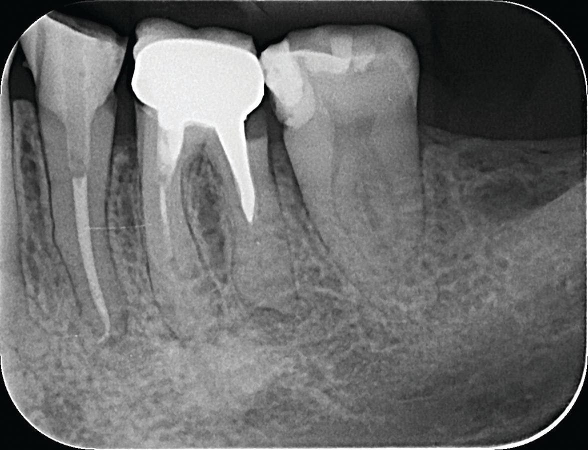 Figure 1. Radiograph of tooth #19 with pre-existing crown, visible periapical lesion, calcified canal and subgingival distal decay.