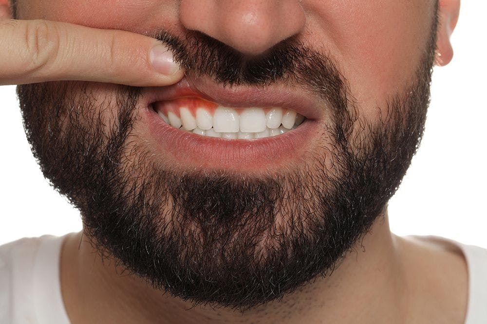 Study Indicates Gum Inflammation Parallels “Cytokine Score”