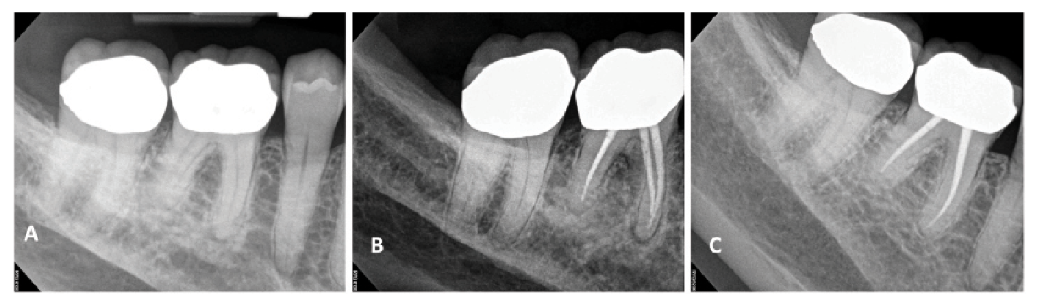 Figure 2. Though cases presenting with preoperative apical periodontitis may have a reduced prognosis, complete apical healing is possible following endodontics. This patient presented with preoperative asymptomatic apical periodontitis on tooth #30 (A). Endodontic treatment was completed on the tooth (B), and at a 5-year follow-up (C) complete lesion healing was noted.