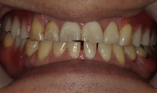 Facial view of the completed maxillary and mandibular ValplastÂ® RPDs