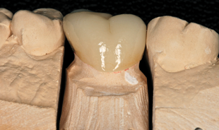 Lingual model view of dental procedure