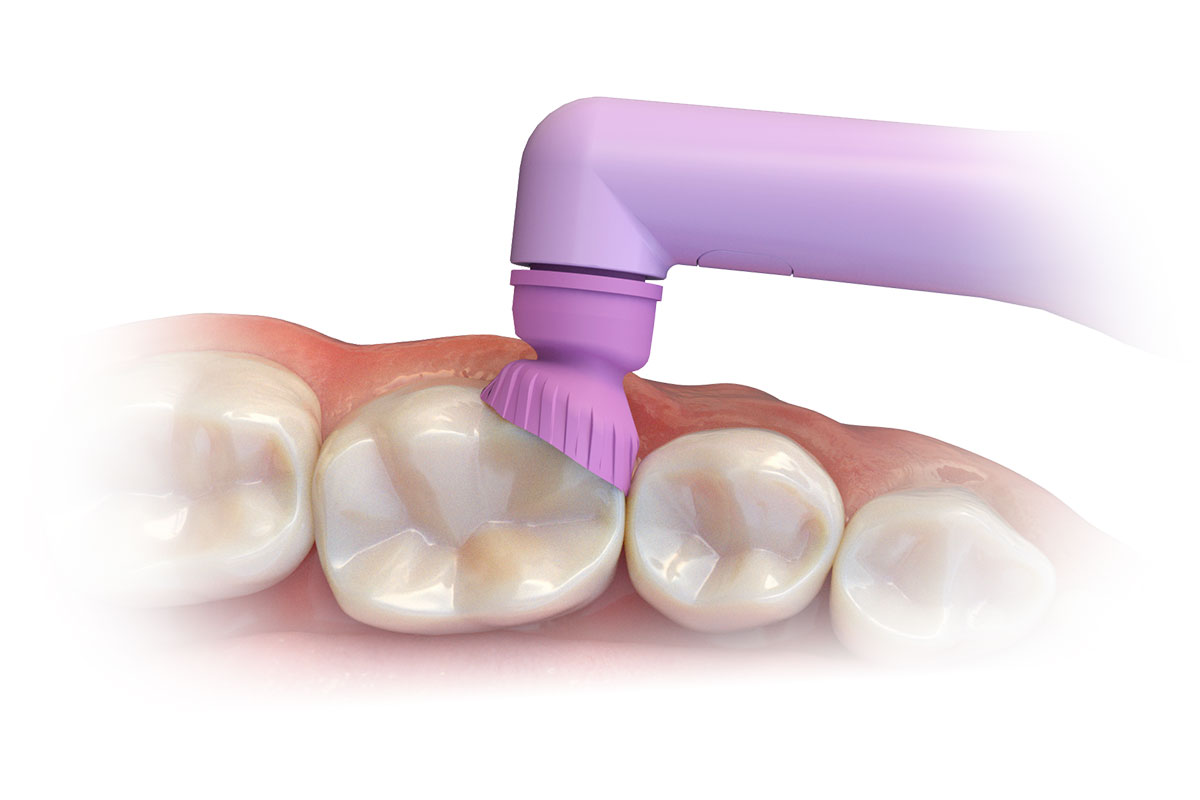 Premier Dental Introduces Innovative ProFlare Disposable Prophy Angle Featuring an Articulating Cup | Image Credit: © Premier Dental