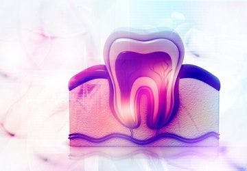 Alzheimer's Drug Could Change How Dentists Treat Large Cavities