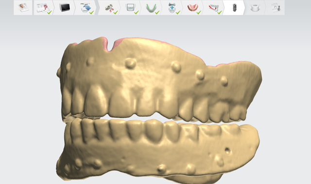 Second scan of individual denture appliances. 