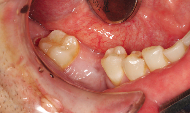 An intraoral photo shows a patient missing a lower-right first molar 