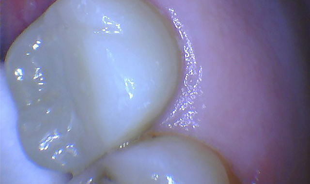 How to perform closed crown lengthening with an all-tissue CO2 laser