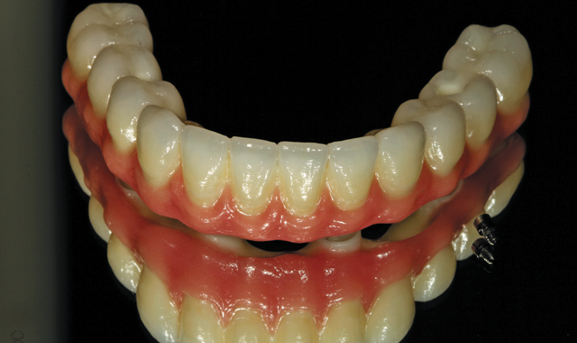 Step-by-step: A better screw-retained zirconia prosthesis