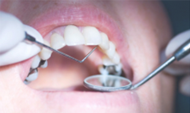 Preps: Preparing for success with your composite restorations