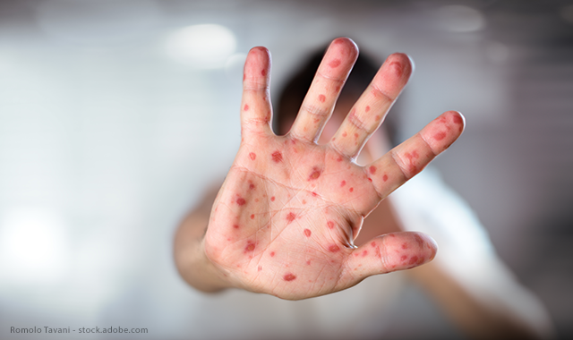 Should you be concerned about measles?