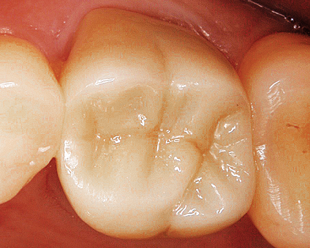Final close-up of dental restoration