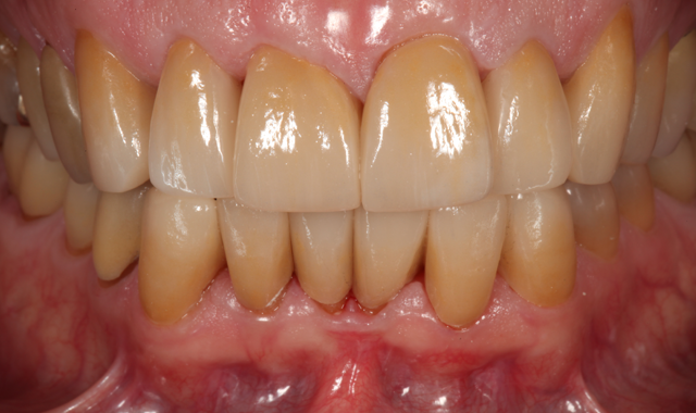Postoperative retracted view of definitive full-coverage crown restorations