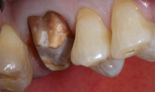 How to use resin cements to bond indirect restorations