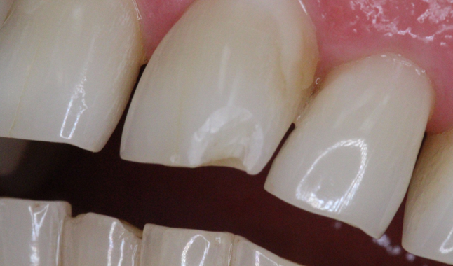 How to: understand multiple applications of adhesive dentistry