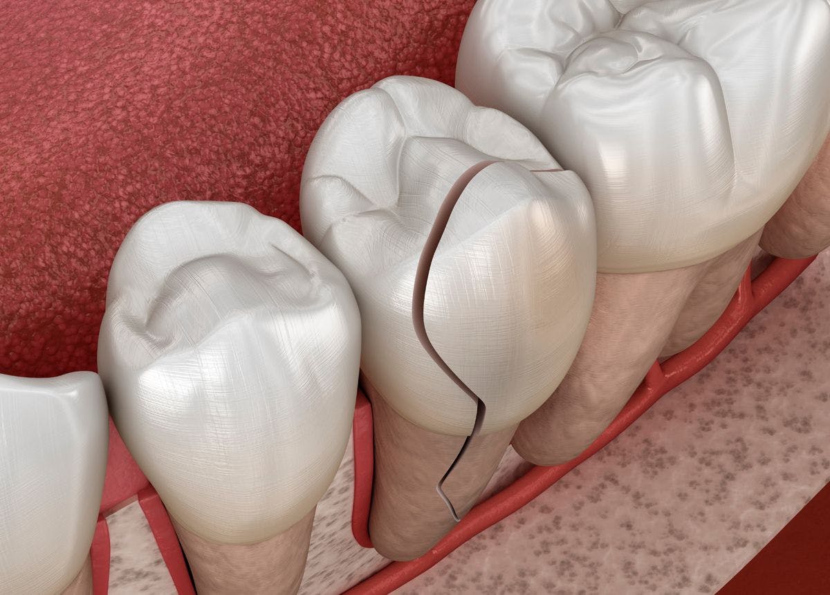 Signs That a Tooth Just Can’t Be Saved. Image: © Alex Mit - stock.adobe.com