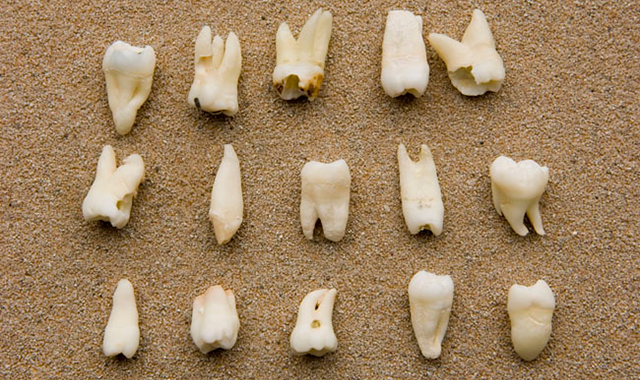 Study finds calcium deficiency due to gene mutation leads to damaged tooth enamel