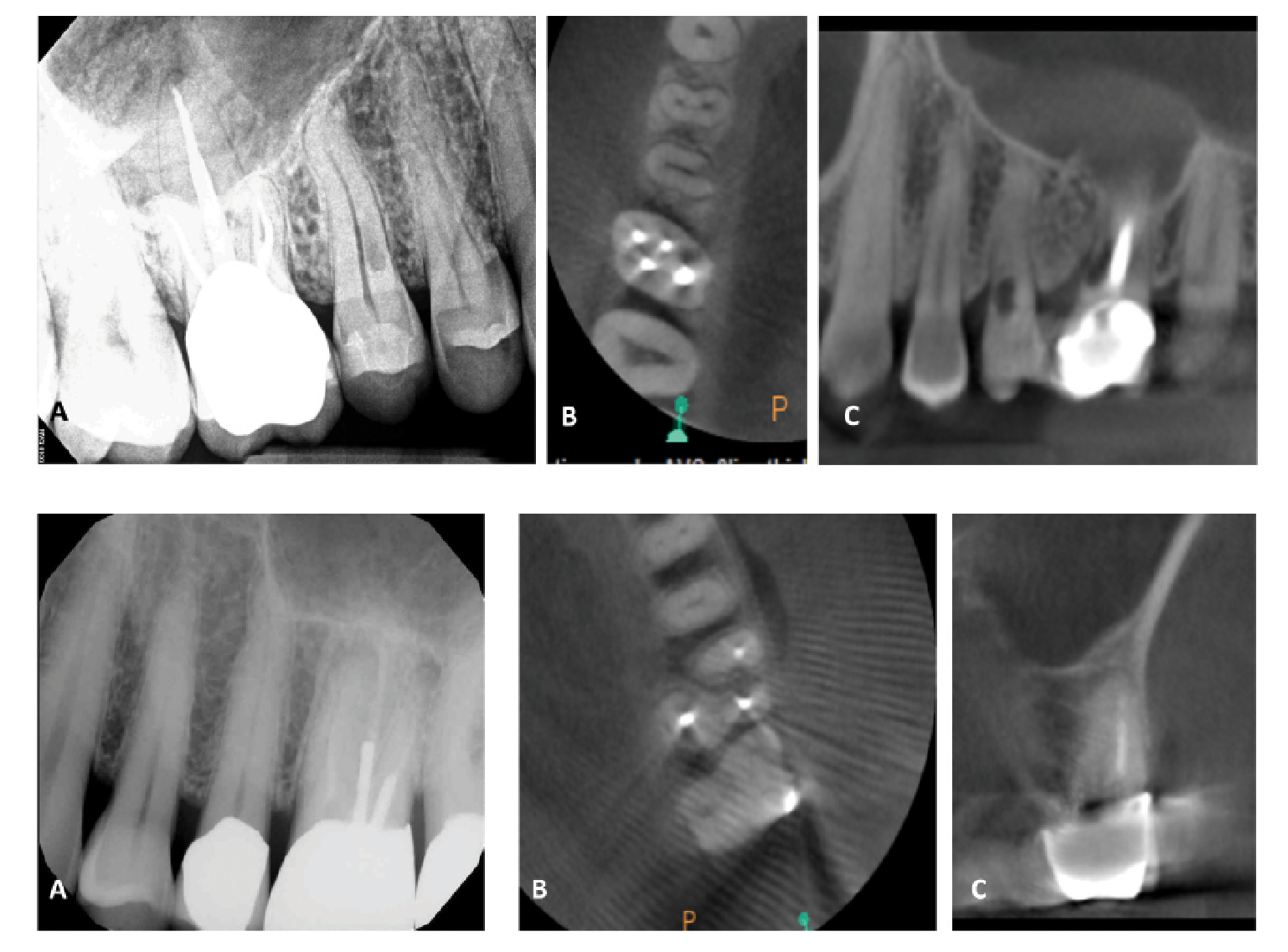 Figure 4 (top). This patient presented for an evaluation of tooth #4, and the periapical radiograph (A) revealed a resorptive defect on the tooth. Further examination with CBCT noted the palatal resorptive defect on the axial (B) and sagittal (C) sections, as well as additional resorptive defects on tooth #3 that would have gone undetected without 3D imaging.Figure 5 (bottom). This patient presented with biting pain associated with a previously treated tooth #14. The periapical radiograph (A) revealed thin root fillings in the tooth as well as the presence of posts. The axial (B) and coronal (C) CBCT sections revealed evidence of untreated anatomy within the mesiobuccal root of the tooth. Based on an understanding of prognostic factors, retreatment was recommended to address the untreated canal.