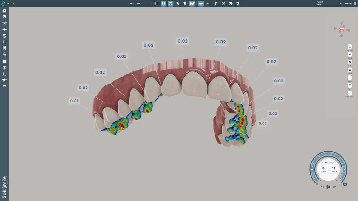 SoftSmile’s first product, VISION, is an artificial intelligence–driven aligner treatment planning software.