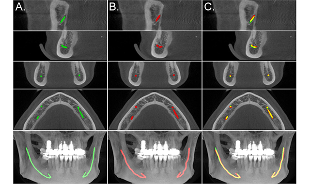 Researchers develop AI model to detect mandibular canals